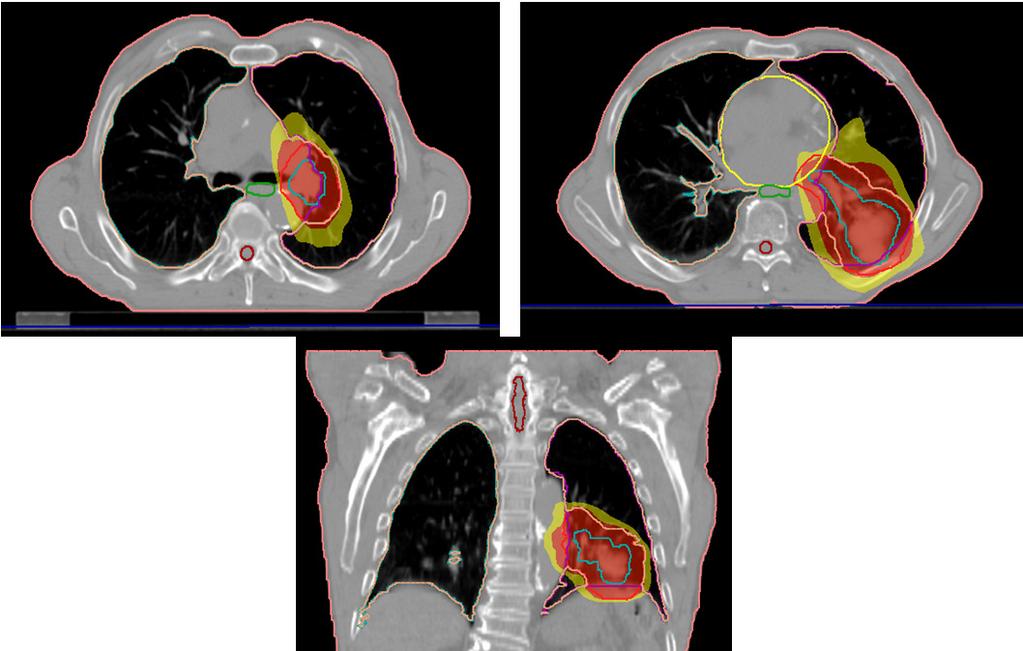 G. T., 73 years old, NSCLC II; RT (66 Gy/