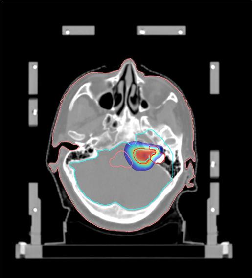 Vestibular Schwannomas and Meningiomas Imaging Imobilization Control of respiratory-induced