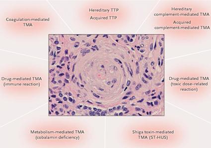 Microangiopatie trombotiche (MAT) Patologie caratterizzate da: - danno ischemico multidistrettuale (da microtrombi arteriolari) -