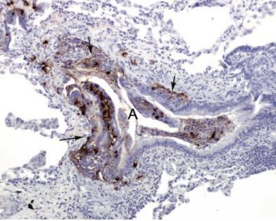 DIPNECH: diffuse idiopathic pulmonary neuroendocrine cell hyperplasia (iperplasia diffusa delle cellule polmonari neuroendocrine) Malattia caratterizzata da iperplasia nodulare