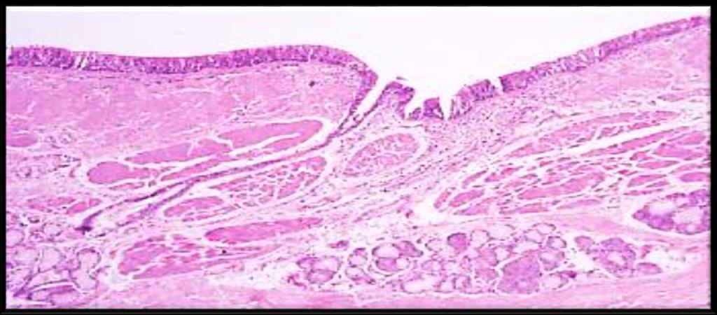 Airway-predominant disease (<6% of