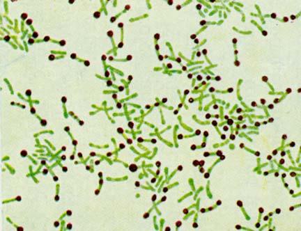 Difterite Infezione localizzata delle membrane mucose o della cute dovuta ad un bacillo aerobio gram positivo, Corynebacterium diphtheriae Alcuni ceppi batterici infettati da un fago che trasporta il