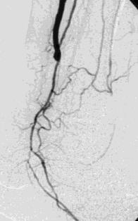 Tecniche endovascolari