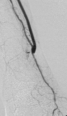 Endoarterectomia Bypass