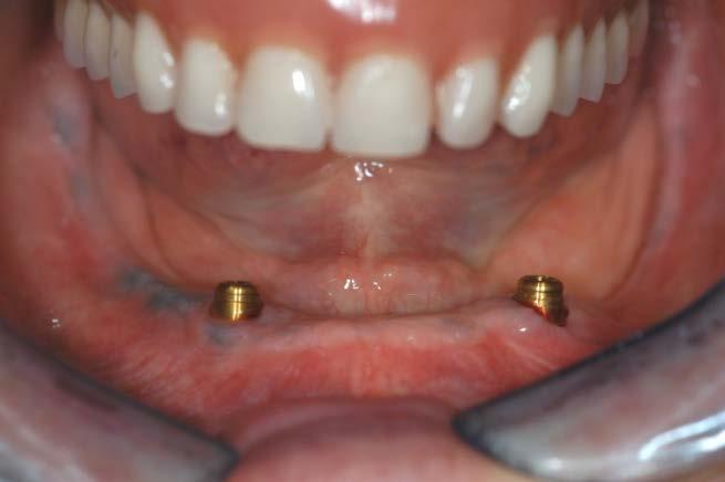 Sinistra. Le femmine della Protesi totale incorporate nella dentiera.