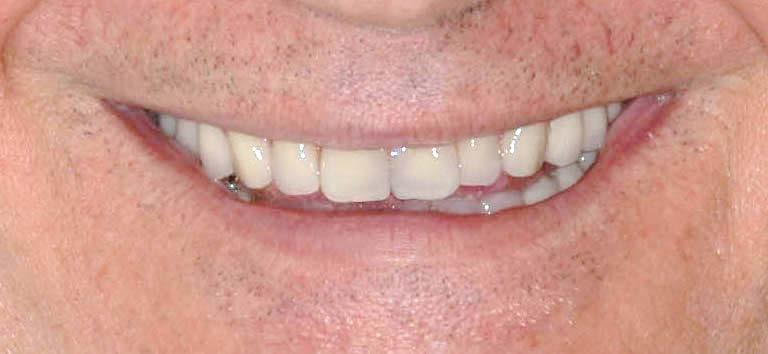 Sono in pratica due Protesi totali, cioè due dentiere, che hanno incorporata la invisibile contro fresatura femmina, che le bloccherà