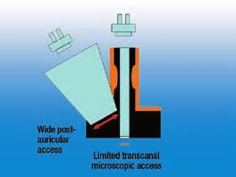 Il grande angolo visuale garantito dall endoscopio consente di utilizzare un accesso mini-invasivo attraverso il condotto uditivo per raggiungere la cavità timpanica e di visualizzare le strutture