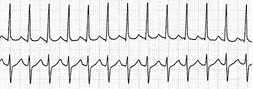 Aritmie ipercinetiche o