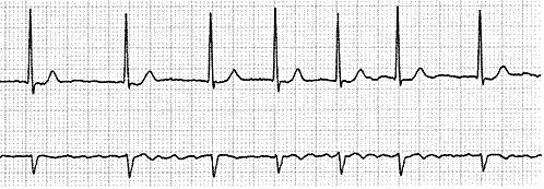 Aritmie ipercinetiche o