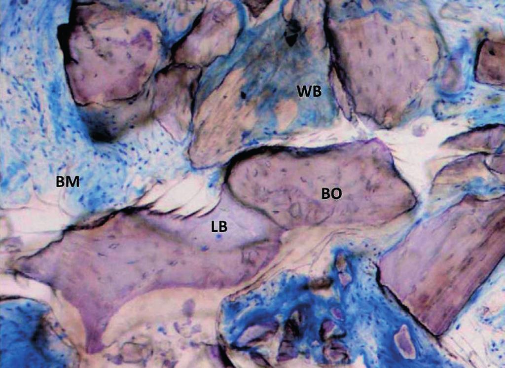 Fig. 4 Immagine, a ingrandimento 100x, di una biopsia ossea prelevata a carico di un alveolo post-estrattivo innestato con BDM, a 6 mesi di guarigione, e colorata con blu di toluidina/ pironina G.