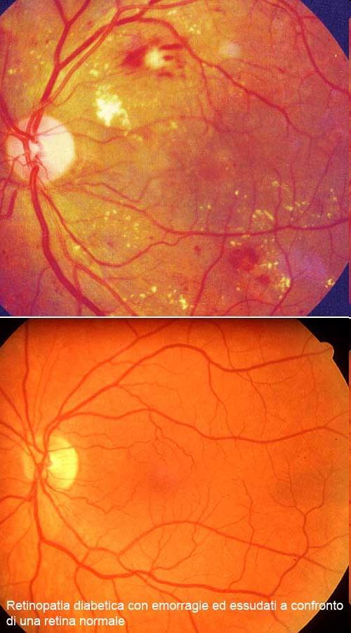 Complicanze oculari Retinopatia diabetica L interessamento oculare nel