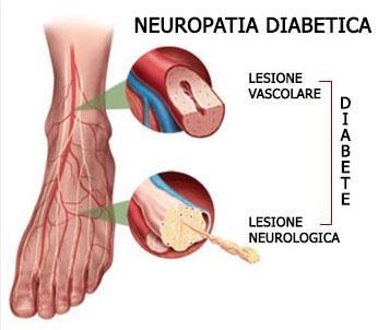 Neuropatia periferica in corso di diabete Neuropatia distale simmetrica sensoriale o sensorialemotoria, la più frequente, determina una riduzione della sensibilità nelle estremità distali e limitate