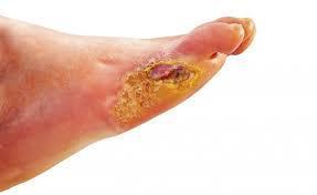 Patogenesi del piede diabetico La perdita della sensibilità dolorifica può determinare la comparsa di ulcerazioni che, a causa dei difetti del microcircolo, hanno