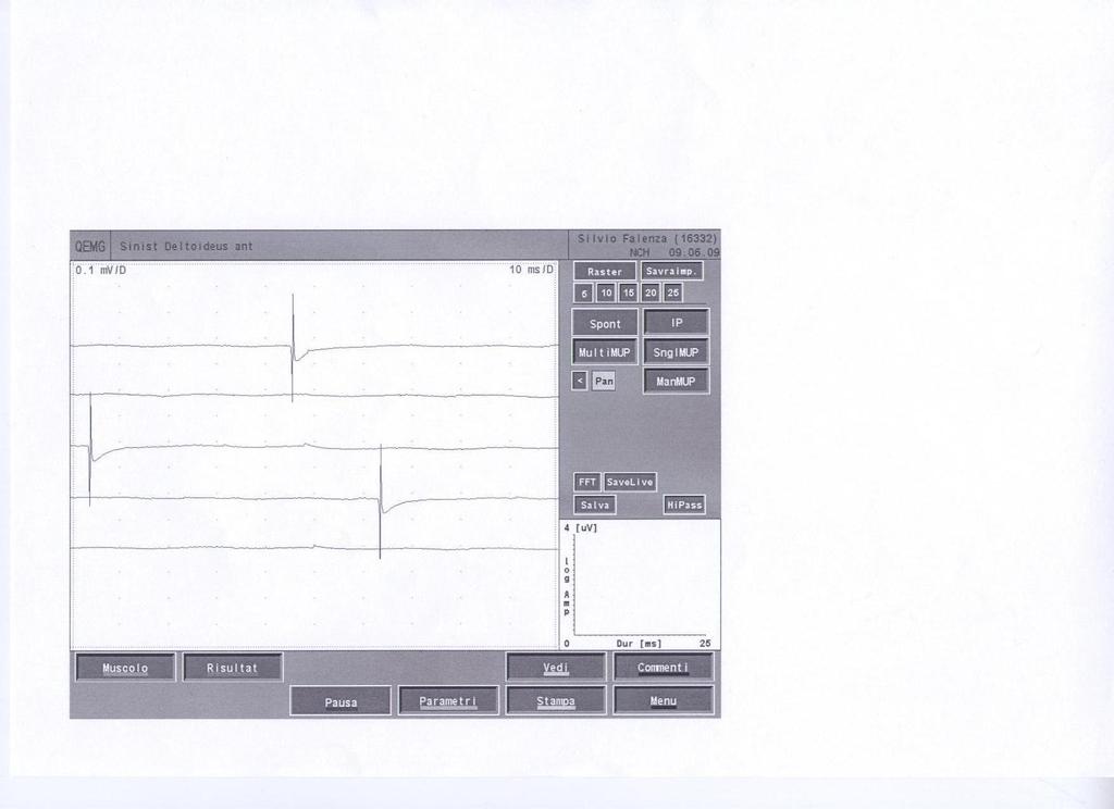 EMG: potenziali