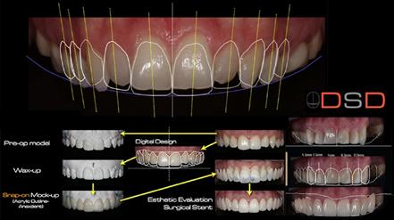 Sistemi digitali per la protesica dentale 13 Tra i principali sviluppi che, a breve termine, è possibile riconoscere come di più probabile diffusione, figurano soprattutto quelli relativi allo smile