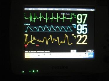 Monitorizzazione del paziente Frequenza