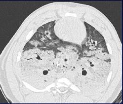DEFINIZIONE Acute Lung Injury (ALI) PaO2/FiO2ratio <300 mm Hg Acute Respiratory