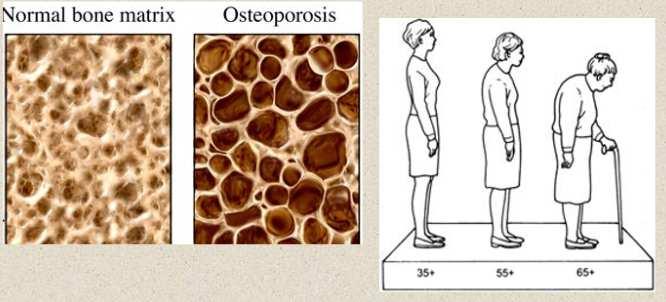 INVECCHIAMENTO DELLE OSSA E OSTEOPOROSI Con l avanzare dell età gli osteoblasti diventano meno attivi degli osteoclasti e si verifica una perdita della massa e della solidità delle ossa.