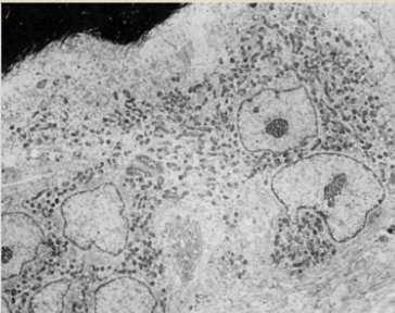 extracellulare - DERIVANO DA CELLULE STAMINALI EMOPOIETICHE: derivano dalla fusione di cellule della linea monocitamacrofago OSTEOCLASTI: CELLULE