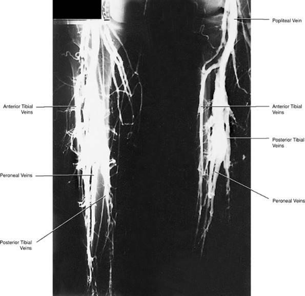 delle vene distali, necessita di particolari protocolli di studio per questo distretto (soprattutto per le vene muscolari) che sono stati modificati nei vari anni(70) e questo spiega in parte perchè