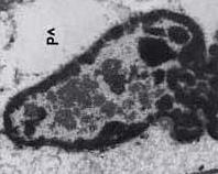 Eziologia del carcinoma del collo