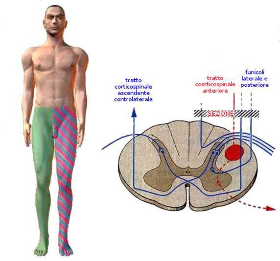 SINDROMI MIDOLLARI Nella forma pura la sindrome di Brown- Sequard si manifesta con paralisi omolaterale (fascio corticospinale), perdita del