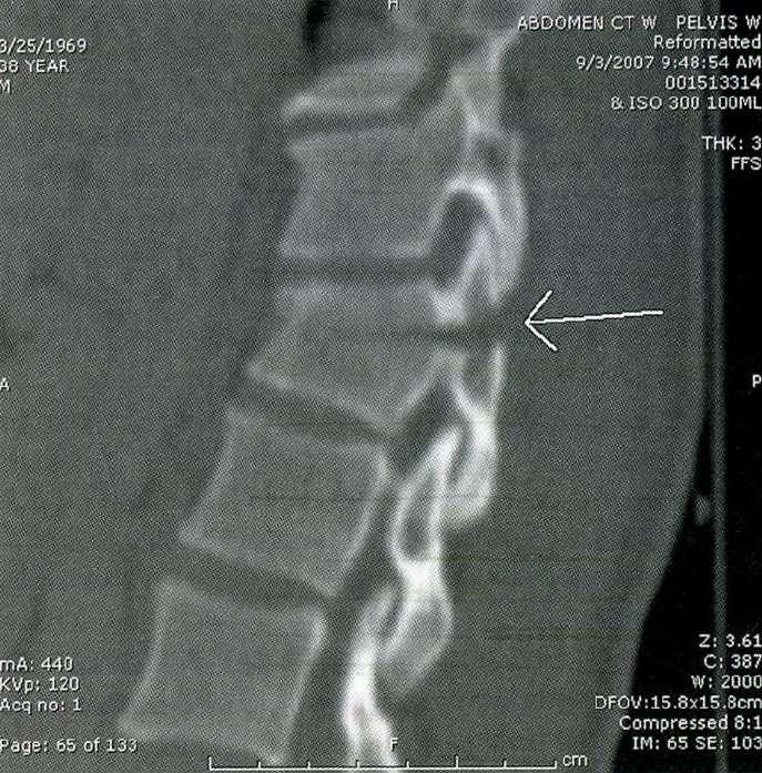 Sono lesioni che attraversano il corpo vertebrale, provocate dalla flessione della colonna
