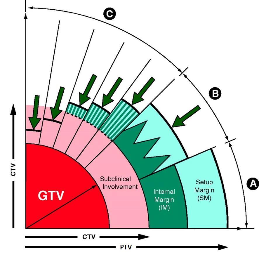 Figura 1.3. Rappresentazione dei volumi GTV, CTV e PTV e dei margini di sicurezza. 1.3.2 Irradiazione La fase di irradiazione è composta a sua volta da due parti: la fase di setup del paziente e l erogazione della dose di radiazione.