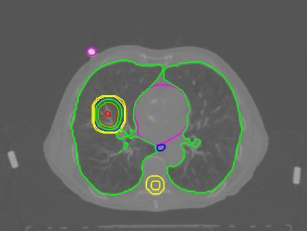 si procede nell acquisizione di una 4D CT sulla quale verrà delineato il volume tumorale da irradiare (Internal Target Volume ITV).