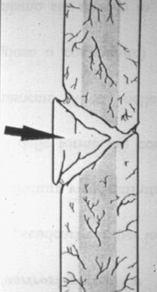 Pseudoartrosi necrotica Su fratture comminute Necrosi avascolare di una o più schegge Formazione di spazi con