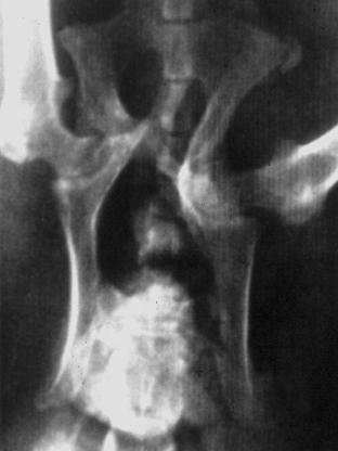patologici Callo osseo deforme