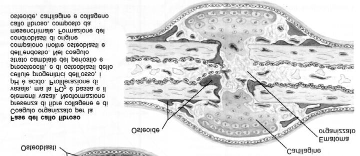 Riparazione indiretta dell osso Fase del callo fibroso o fibrocartilagineo Penetrazione centripeta di ansate vascolari Attività macrofagica ed riassorbimento osteoclastico sui margini necrotici