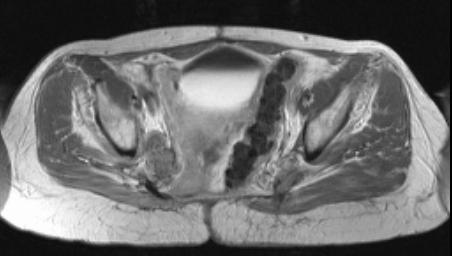 Esame di scelta: risonanza magnetica nucleare (MRI) La TAC TB serve, in