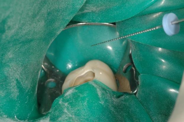 Il suo scopo è di: 1) mantenere la sterilità all interno del dente, in quanto usando strumenti sterili, non vogliamo contaminare l endodonto con i germi della saliva, 2) ma fondamentalmente di