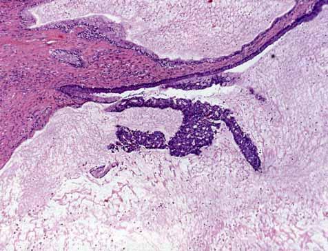 CARCINOMA DELL URACO origine da residui di uraco ; meno