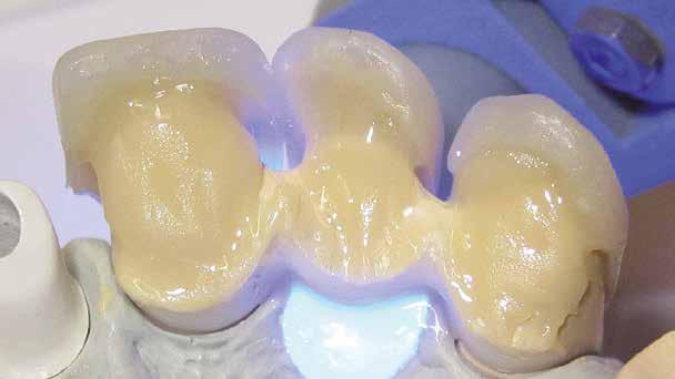 lign incisali, GUM, modificatori e dentinali lo spessore dello strato non deve essere superiore ad mm, previa pre-polimerizzazione intermedia di 80 secondi.