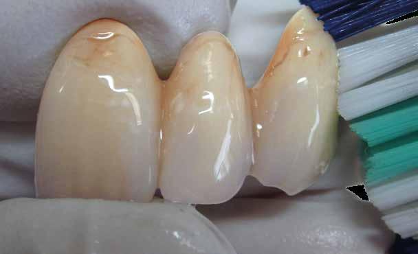 marginali con massa dentinale BL.