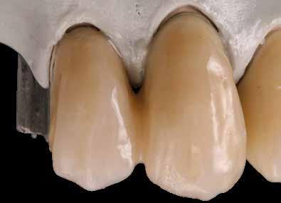 sec Con la massa dentinale crea.lign in pasta A è stata realizzata la stratificazione del corpo del dente.