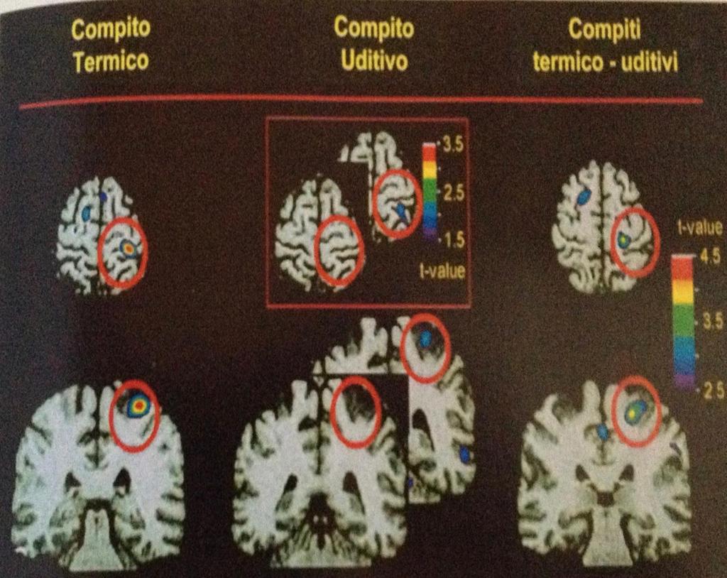Attenzione Quando i soggetti prestano attenzione allo stimolo nocicettivo termico la corteccia somatosensoriale primaria è attivata, L attività