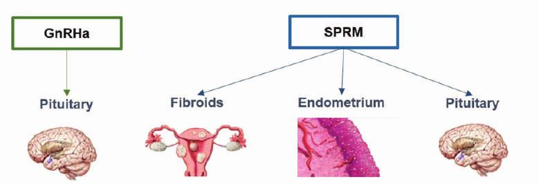 Terapie mediche per miomi nelle pazienti infertili L Ulipristalacetato (UPA) ha un azione mista agonista-antagonista sui recettori del Progesterone con effetto antiproliferativosulle lesioni