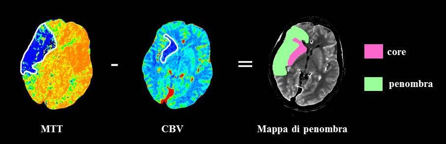 Il classico concetto di mismatch CTP Wintermark M et al. Stroke 2006; 37: 979-985; Konstas AA et al. Am J Neuroradiol 2009; 30: 885-892 Sanelli PC et al.