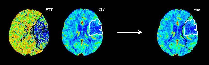 J Neurointerv Surg 2016; Epub ahead of print; Padroni M et al.