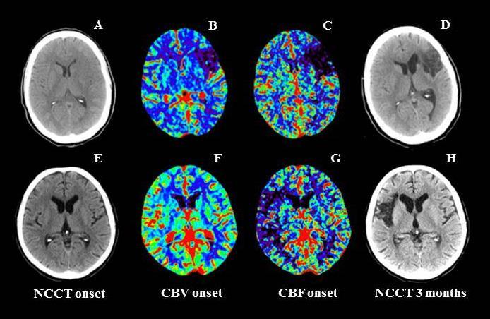 J Stroke Cerebrovasc Dis 2015; 24: 2306-2312 l iperemia che caratterizza la