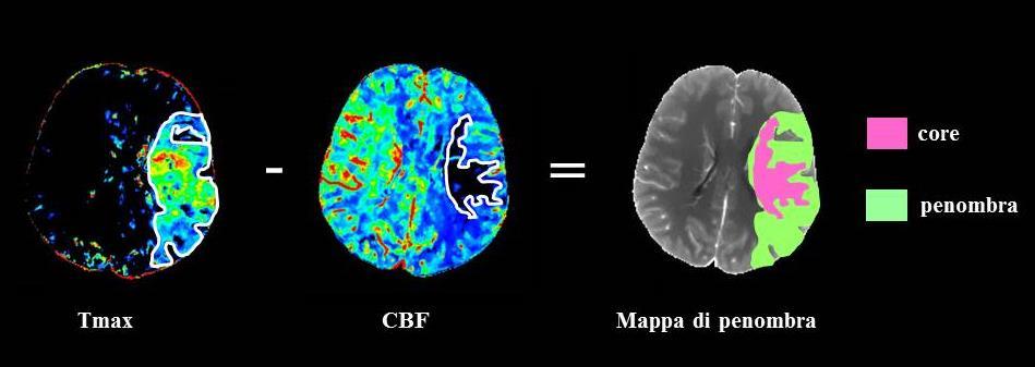 Il nuovo modello di mismatch CTP Campbell BCV et al. Stroke 2011; 42: 3435-3430; Bivard A et al. Brain 2011; 134: 3408-3416; Campbell BCV et al. Stroke 2012; 43: 2648-2653; Bivard A et al.