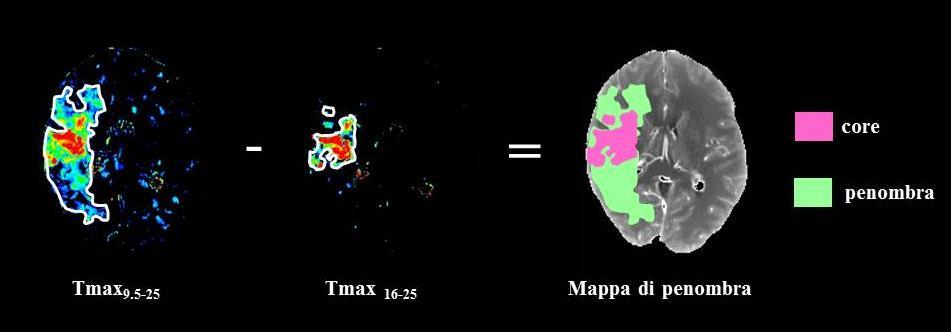 Il mismatch Tmax - Tmax d Esterre CD et al. Stroke 2015; 46: 3390-3397 ipoperfusione totale = dimensioni della lesione Tmax (Tmax > 9.