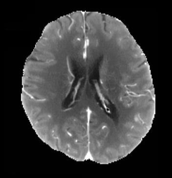 5-25sec CBF 8-80ml/100gr/min d Esterre CD et al.