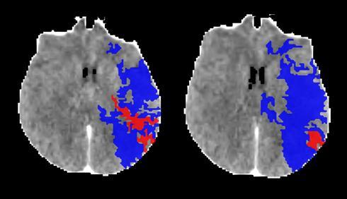 ischemia = Tmax > 9.