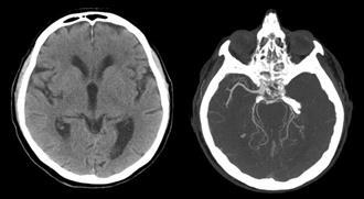 Int J Stroke 2015; 10: 1119-1129 ore dall esordio 6 NIHSS