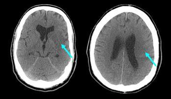 Nat Rev Neurol 2010; 6; 560-571 - riconosce le patologie che