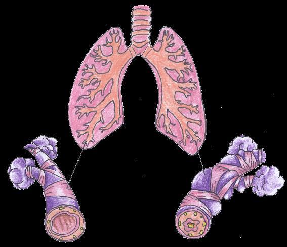 una crisi d asma Durante una crisi di asma, l apertura dei bronchi è ridotta, provocando spesso una tosse
